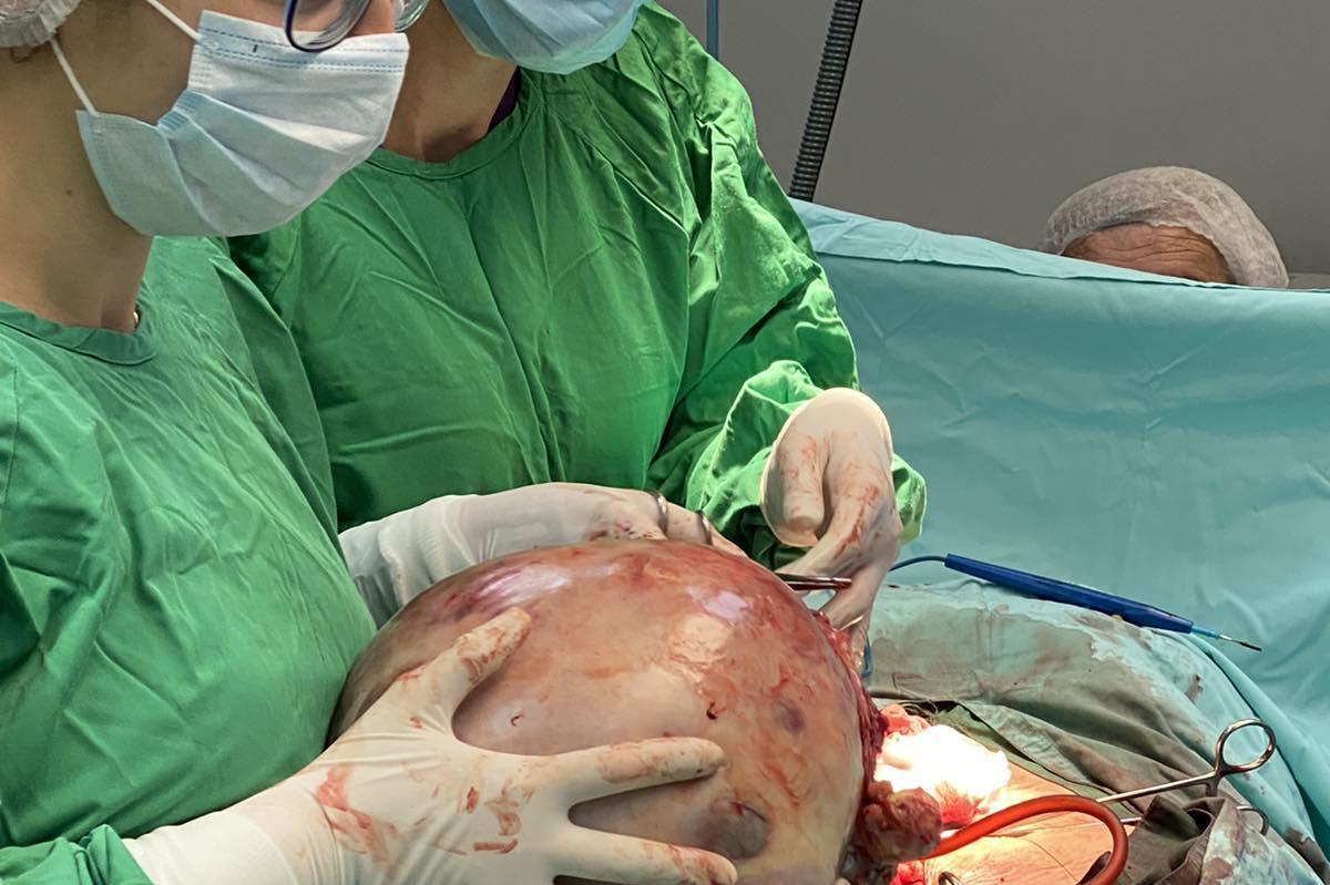 В болница "Света София": Махнаха 12-килограмов тумор от пациентка