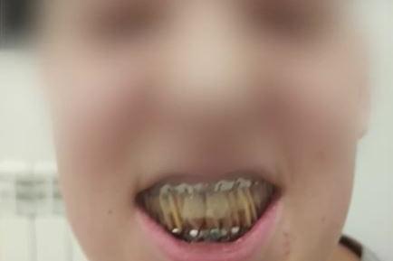 Момче счупи челюстта на 13-годишен в Костенец