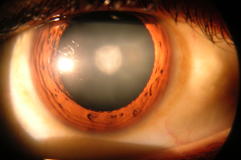 Столичен офталмолог: Операцията за катаракта на окото се „подмладява“