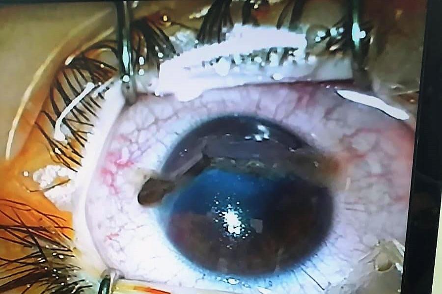 Столични лекари спасиха окото на дете, ранено при игра с лък (СНИМКИ)